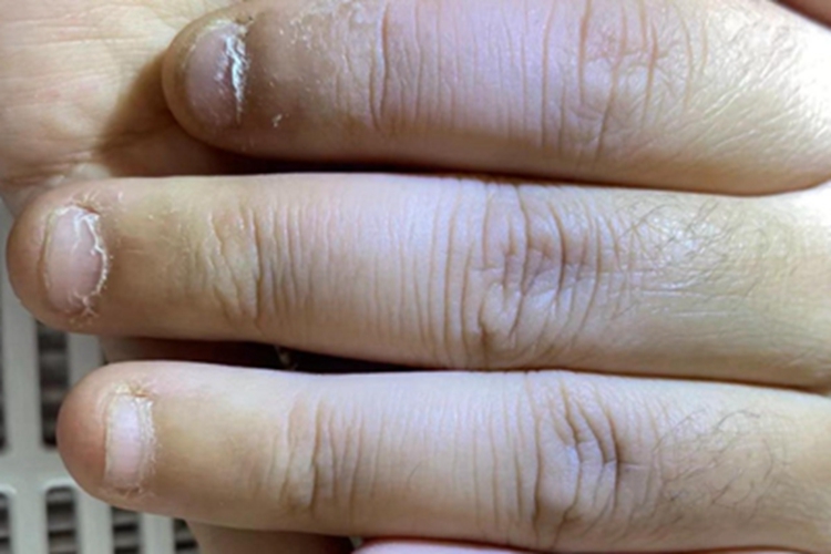 指甲萎缩手指甲变小图