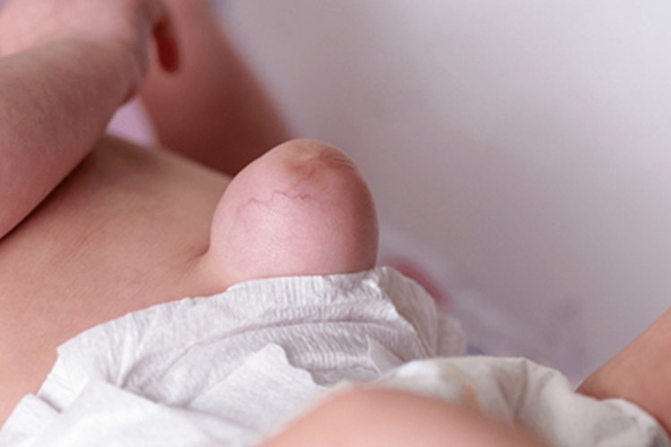 小儿脐疝肚脐鼓大包图