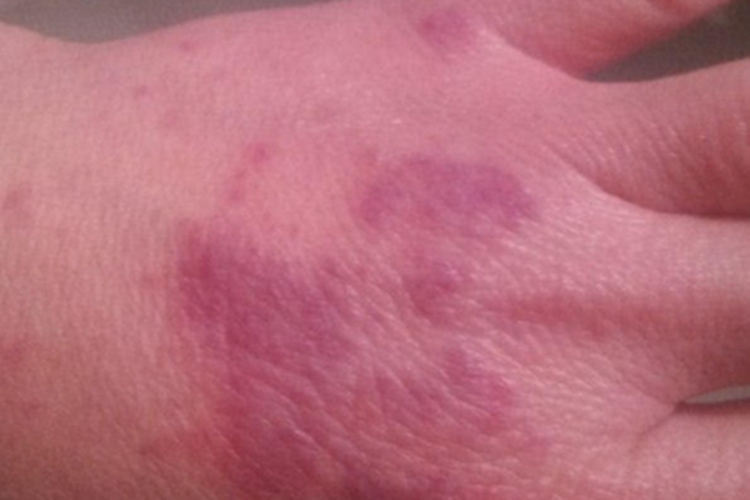 可变性红斑角化病手背皮肤粗糙图