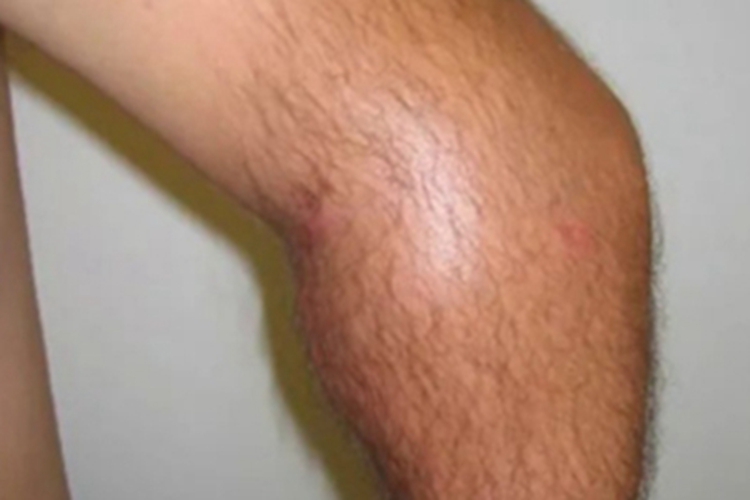 滑膜肉瘤腿部症状图