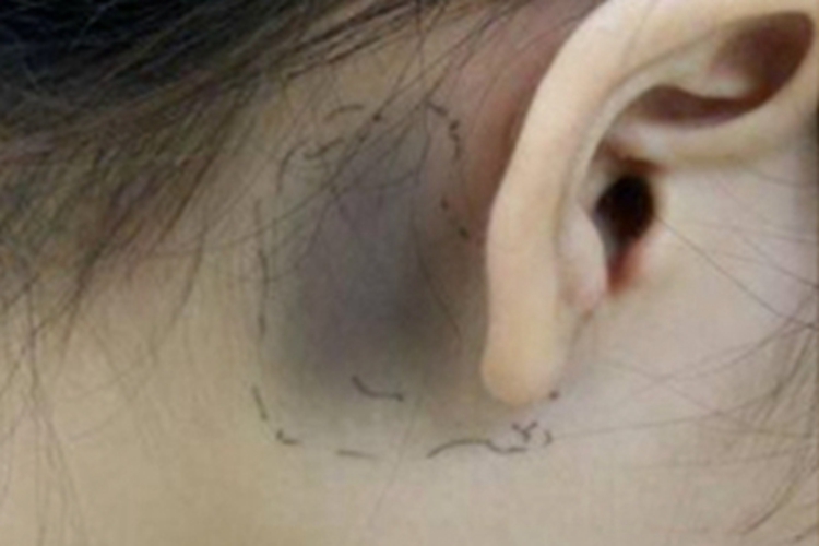 伊藤痣耳后斑图