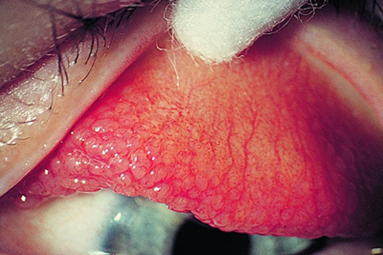 巨乳头性结膜炎眼睑红肿图