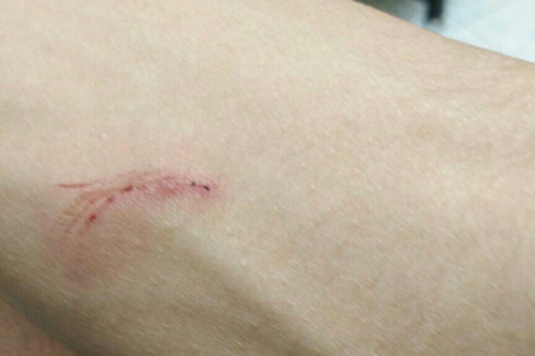 割伤手臂有红血印子图 割伤手臂有红血印子图
