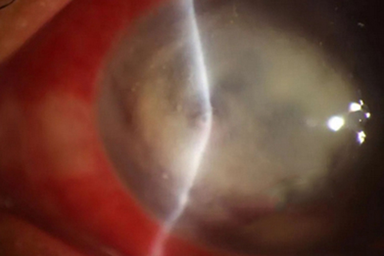 细菌性角膜溃疡黑眼球上有白斑图 细菌性角膜溃疡黑眼球上有白斑图