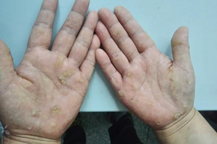 砷角化病手掌症状图