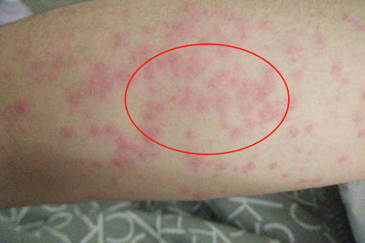 梅毒小腿上红点图 梅毒小腿上红点图