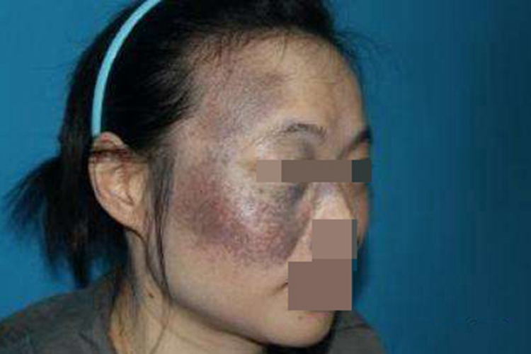 太田痣脸上有多种颜色斑块图