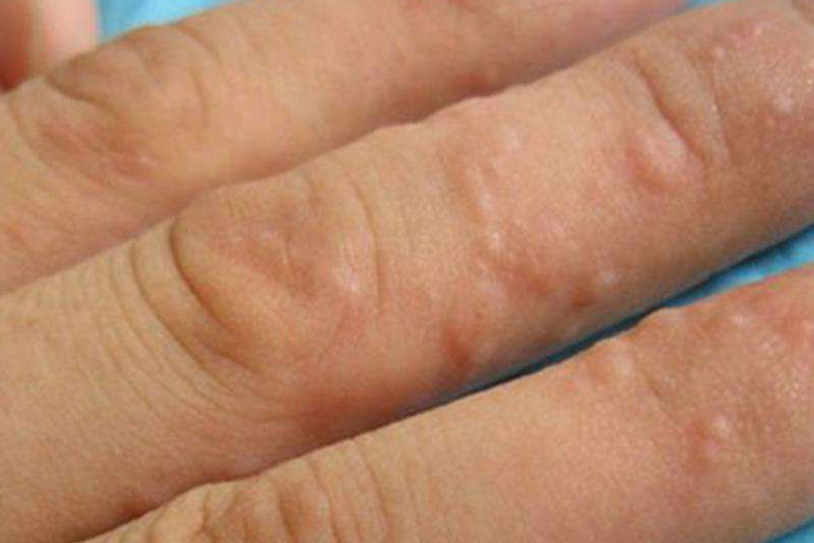 手足癣,特别是足癣,是最常见的浅部真菌病,夏秋季发病率高