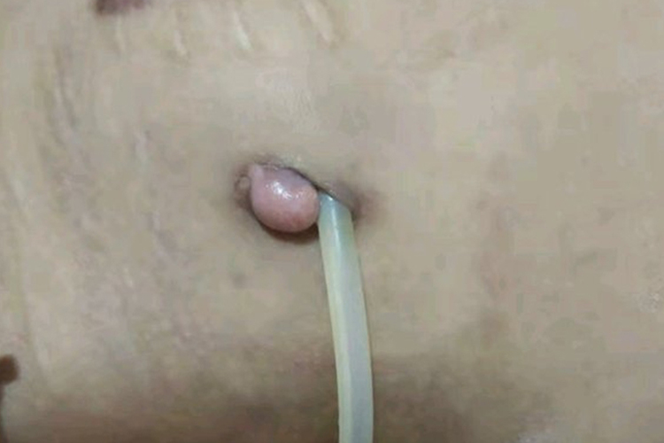 腹透管口长出肉芽图