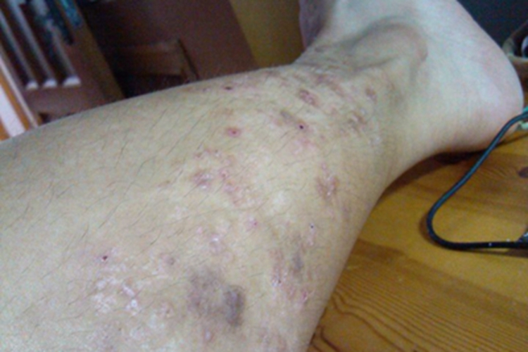 冬季瘙痒症小腿结痂图