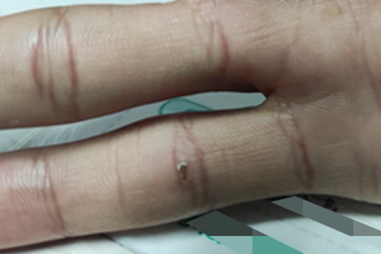 寻常疣小拇指上有小块结痂图 寻常疣小拇指上有小块结痂图