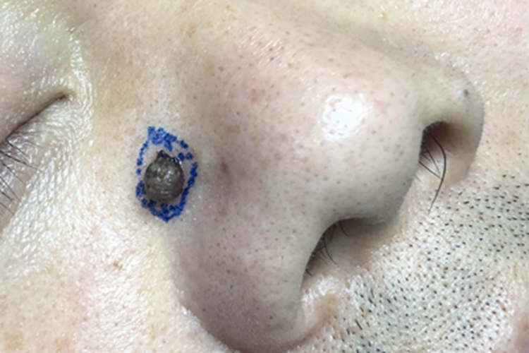皮内痣面部肉球图