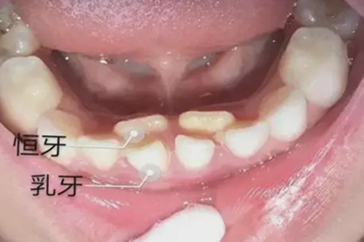 乳牙滞留下颌中间出现两排牙图