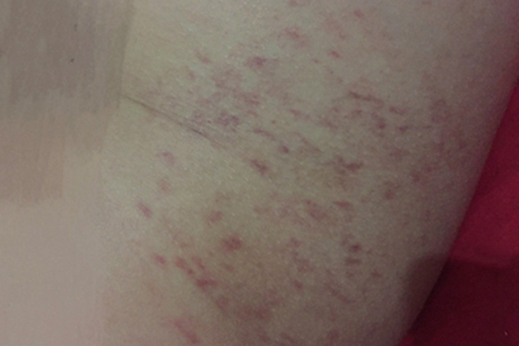 机械性紫癜臀部紫斑图