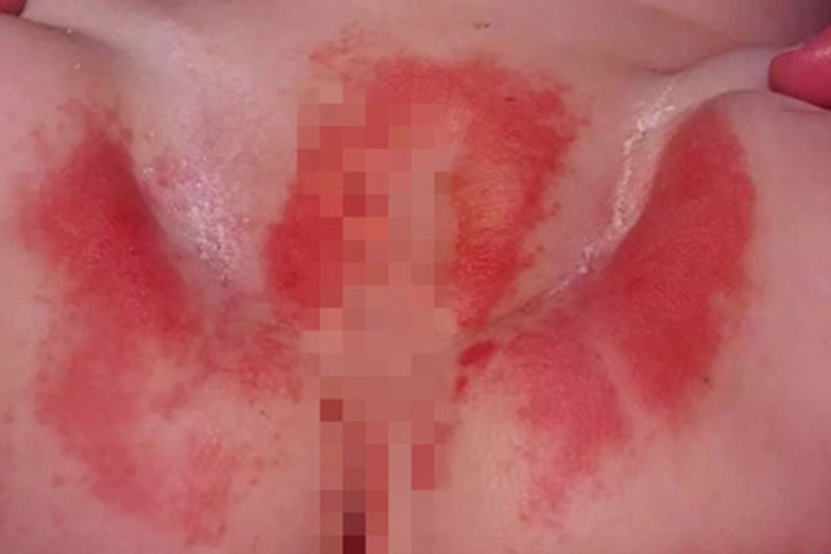尿布皮炎大腿根有鲜红斑块图