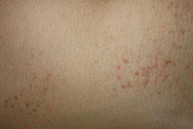 瘰疬性苔藓红点图