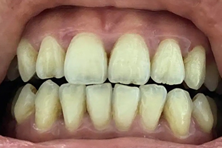 牙龈薄能看到牙根图