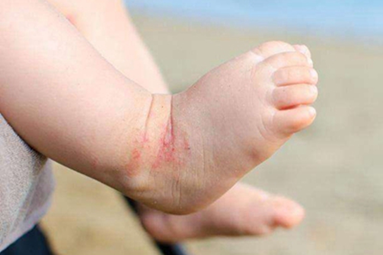 渗出型婴儿湿疹脚踝红斑图