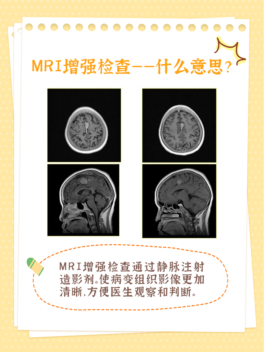 医生解析：MRI增强检查是什么意思