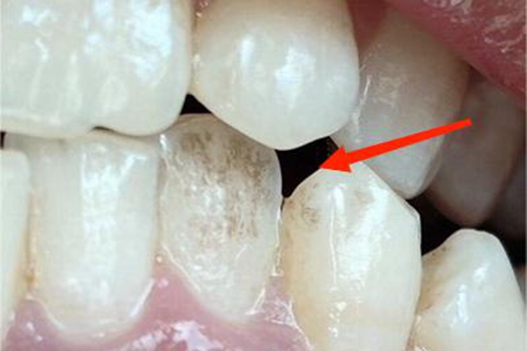 牙齿色素沉着症状图