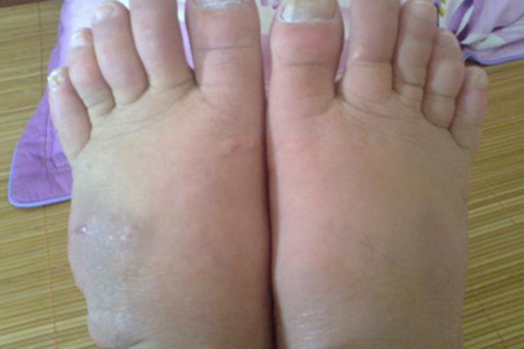 胫前黏液性水肿足背长斑图