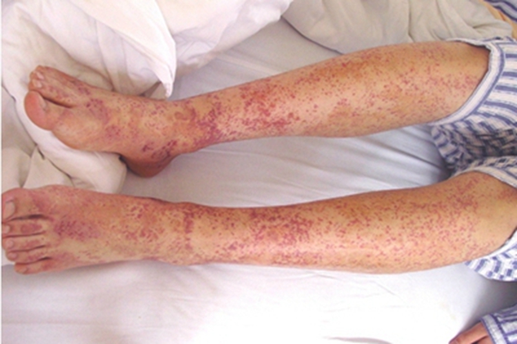 皮下出血小腿紫癜图