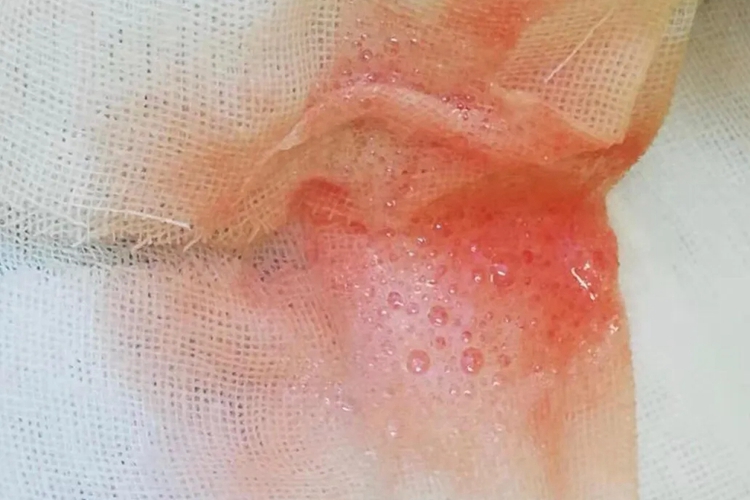 二尖瓣狭窄粉红色泡沫痰图