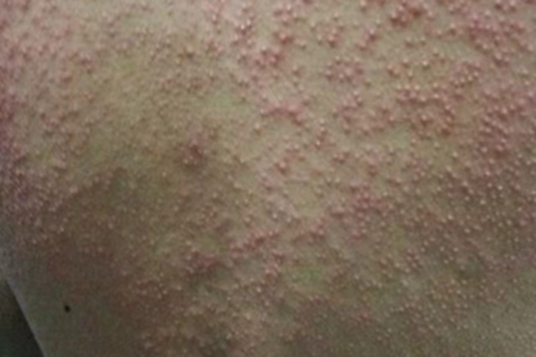 过敏性皮炎背部小红疙瘩图 过敏性皮炎背部小红疙瘩图