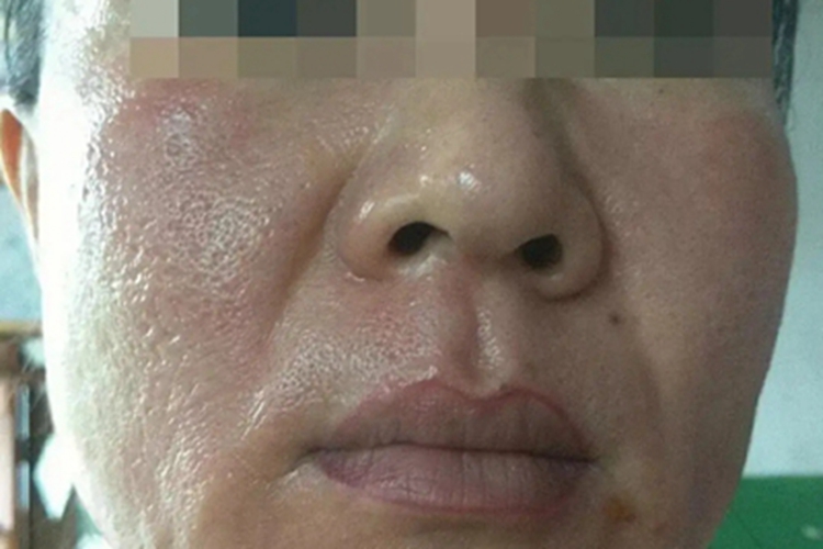 糖皮质激素依赖性皮炎皮肤增厚图 糖皮质激素依赖性皮炎皮肤增厚图