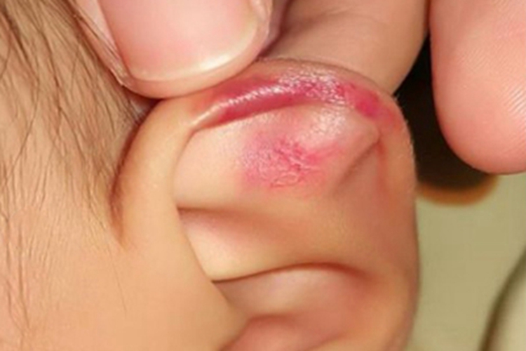 耳廓挫伤耳朵长紫斑图