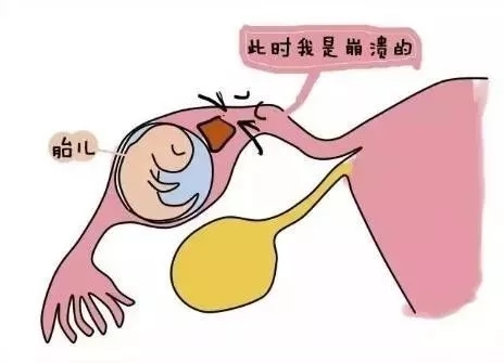 宫外孕.webp.jpg