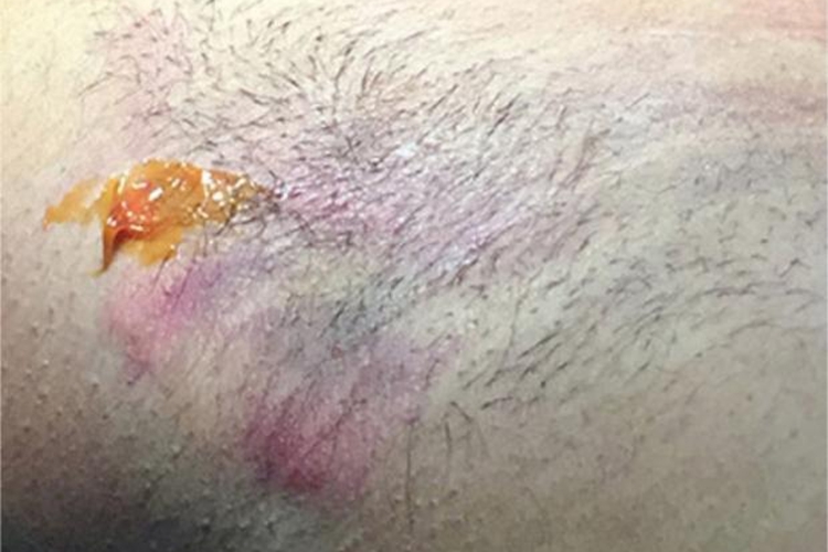 Ⅰ期化脓性汗腺炎腋窝长红疙瘩图