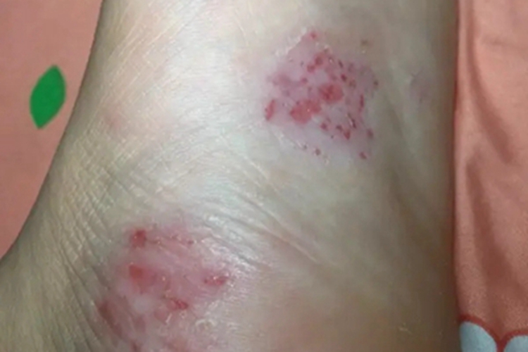 药物过敏性口炎脚底症状图