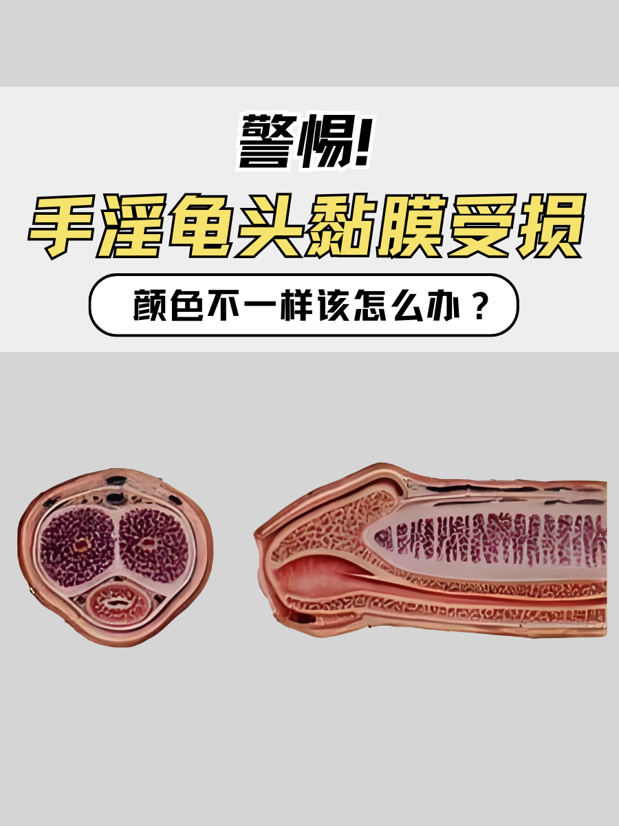 警惕！手淫龟头黏膜受损，颜色不一样该怎么办？