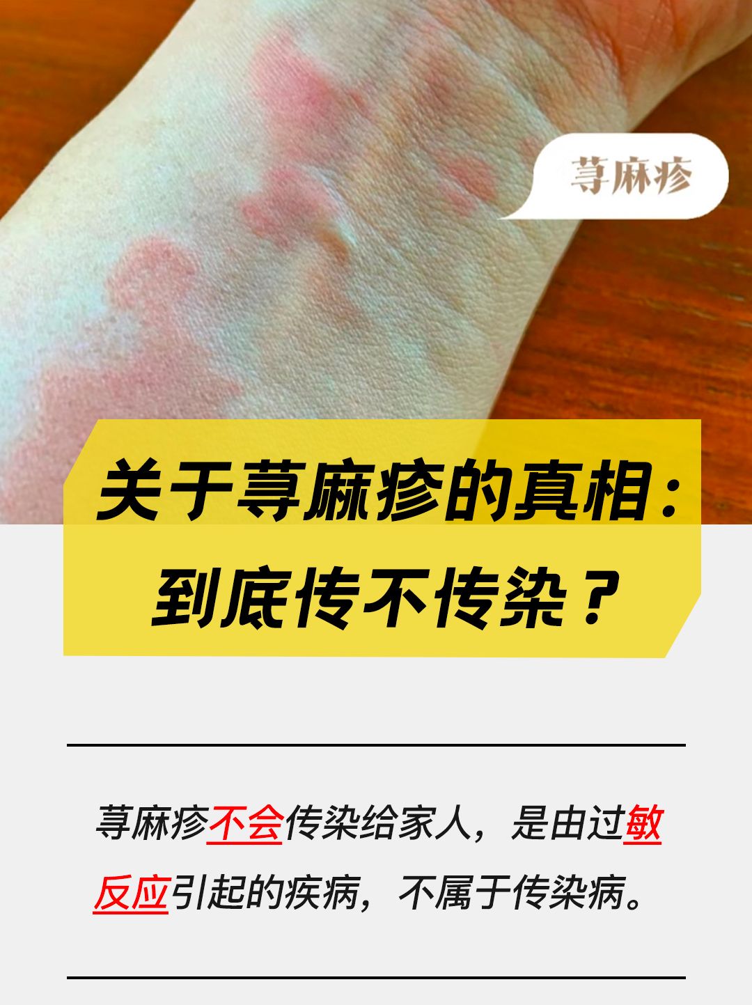 关于荨麻疹的真相：到底传不传染？