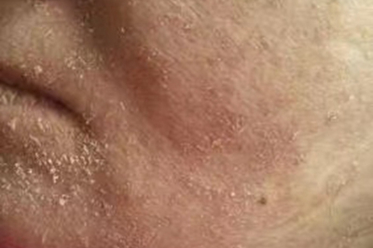 典型麻疹恢复期脱屑图