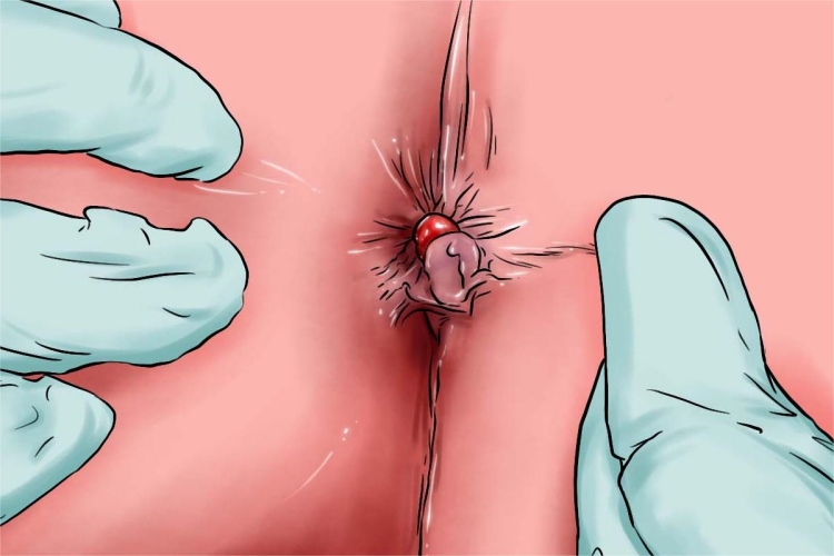 Ⅱ度内痔疙瘩手绘图 Ⅱ度内痔疙瘩手绘图