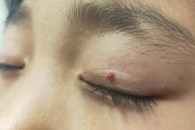 化脓性肉芽肿眼睑疙瘩图