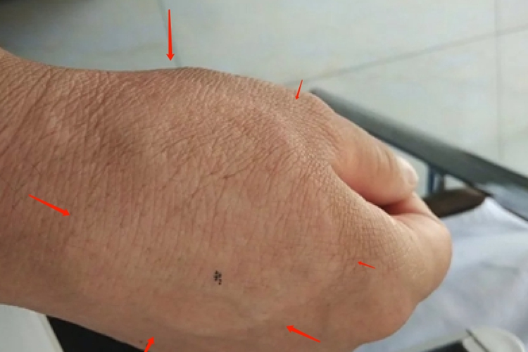 麻风病皮肤增厚图