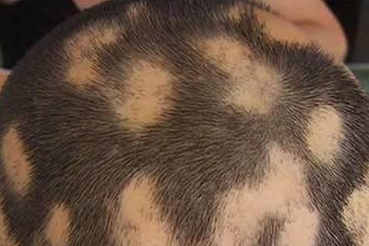 斑秃头皮脱发区融合成片图