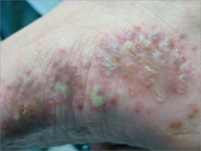 为什么会长汗疱疹