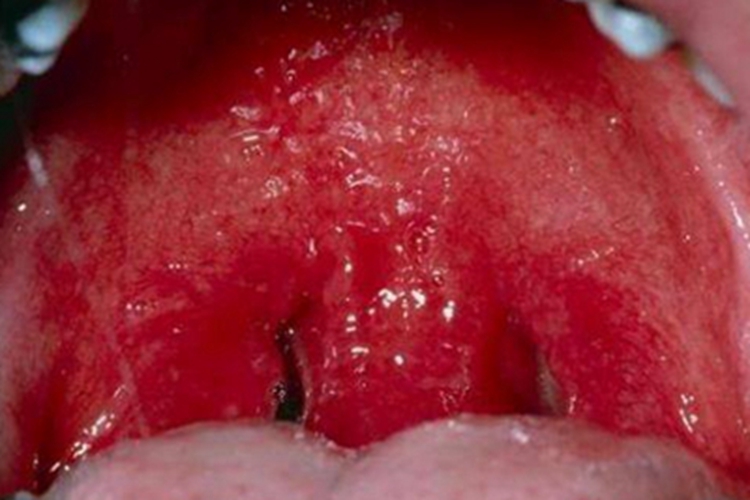 急性咽炎咽炎红肿图