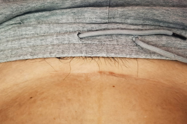 剖腹产瘢痕停止增生平软图