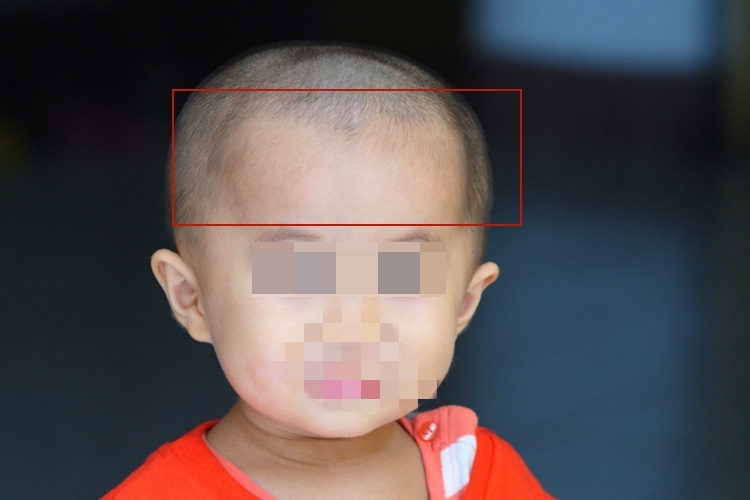 佝偻病额骨前突图