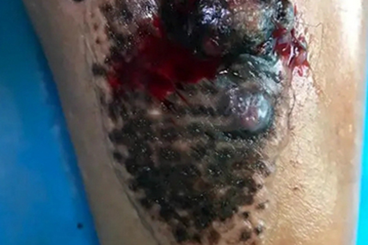 恶性黑色素瘤小腿结节图 恶性黑色素瘤小腿结节图