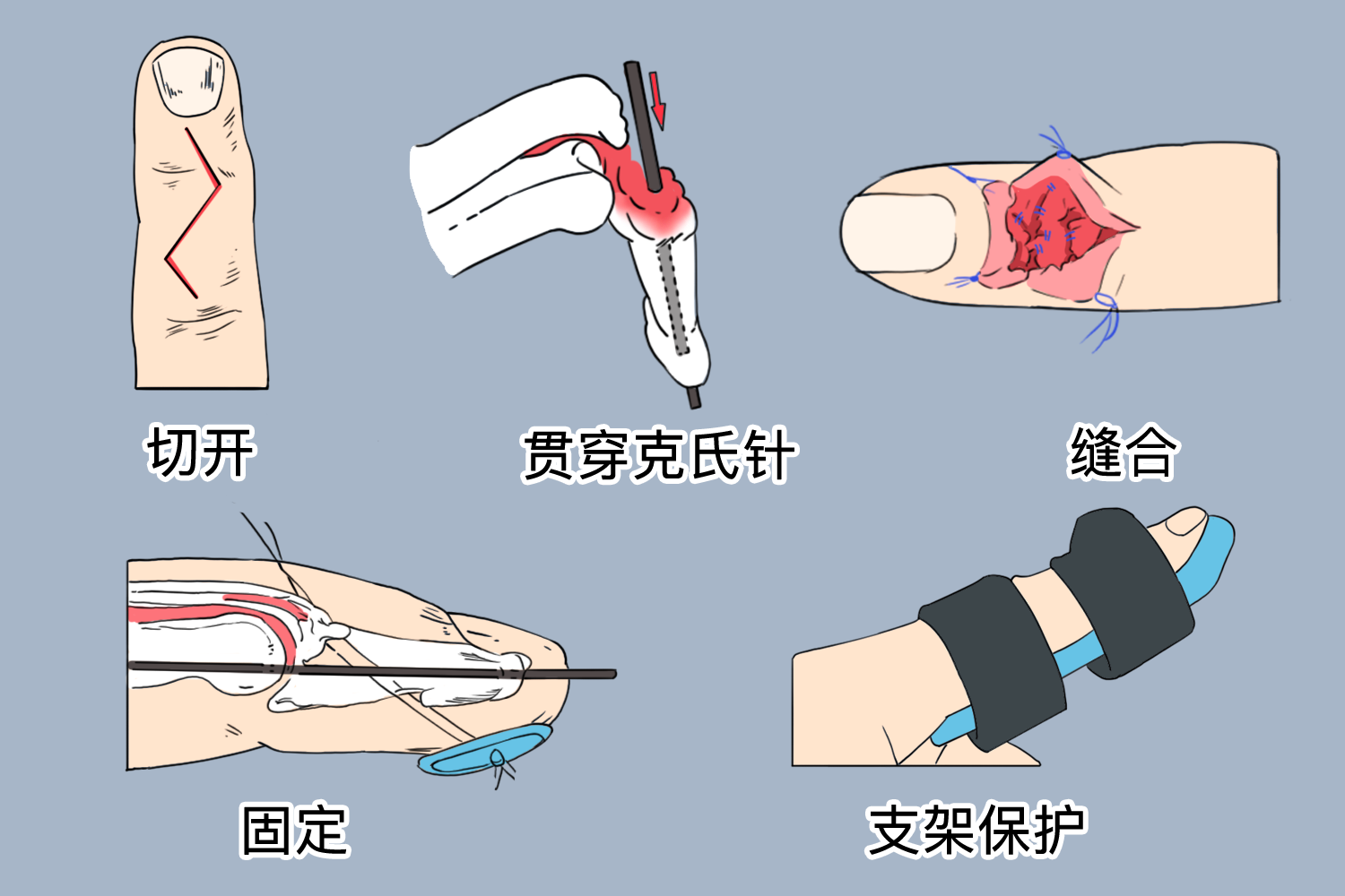 闭合性锤状指