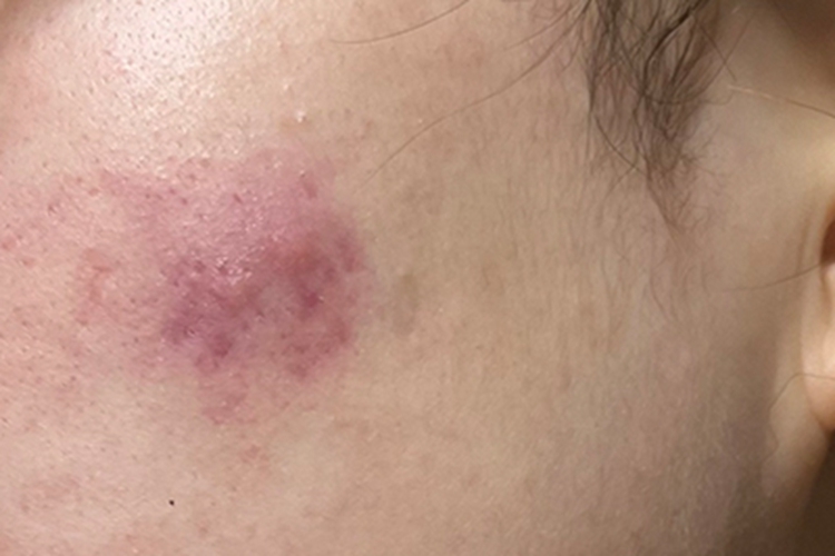 痤疮脸上有一块红斑图