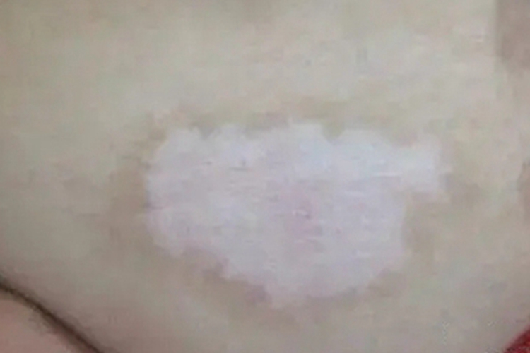 进展期节段型白癜风腹部症状图