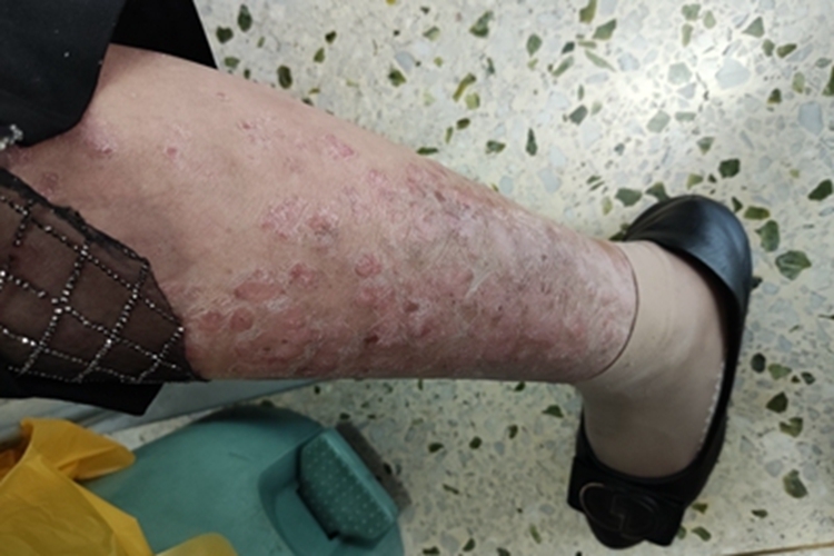 亚急性湿疹小腿症状图
