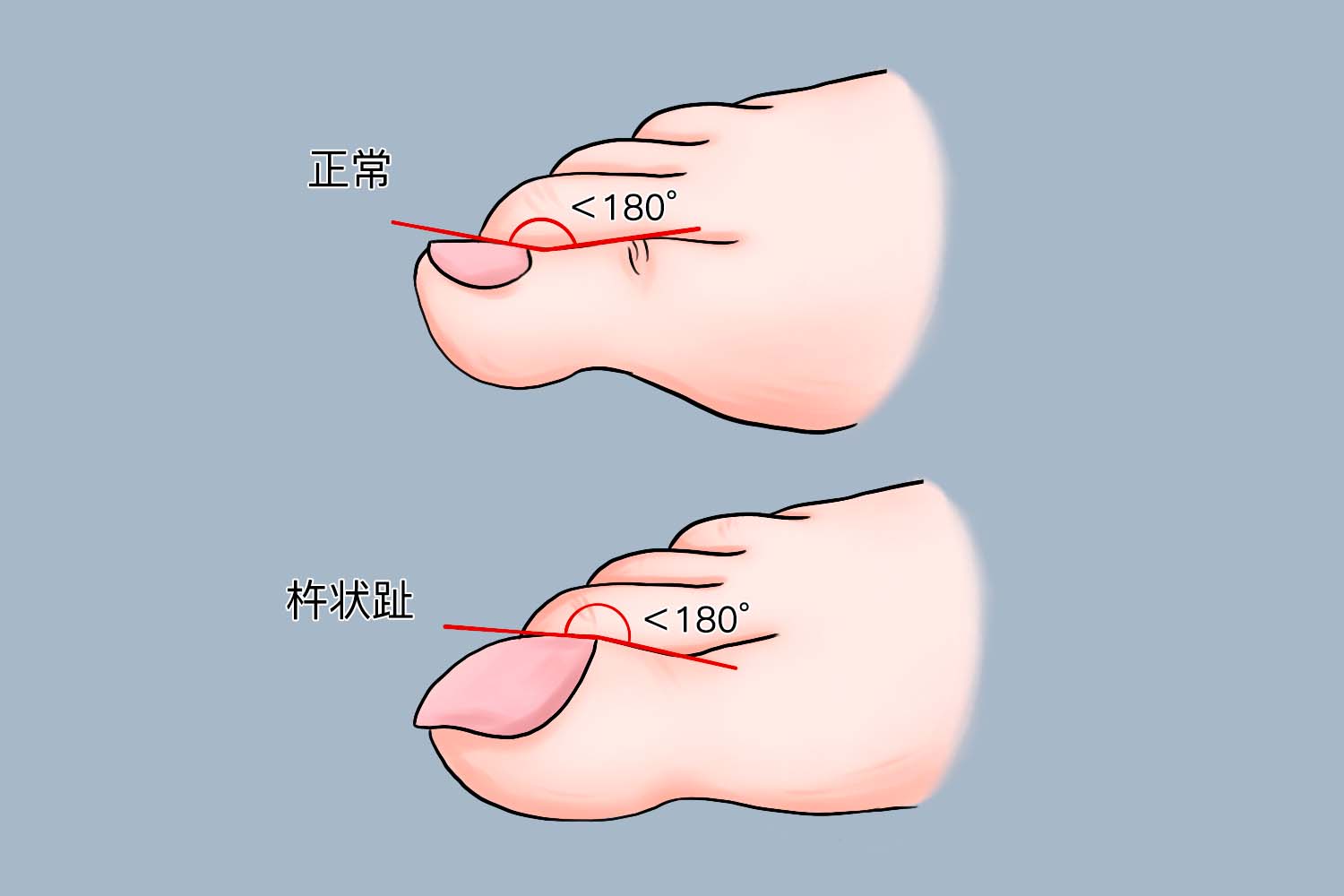杵状趾基底角度数测量图 杵状趾基底角度数测量图